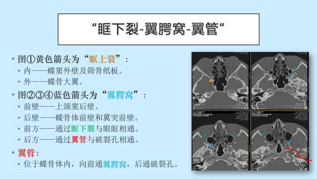 影像PPT - 【PPT】颅骨的孔裂、缝及骨折线CT读片-18