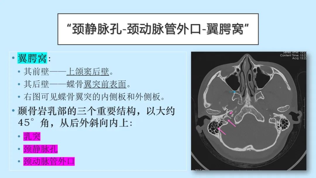 影像PPT - 【PPT】颅骨的孔裂、缝及骨折线CT读片-19