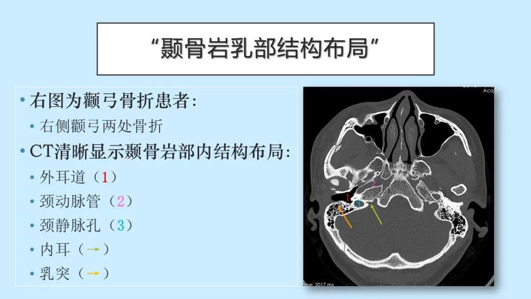 影像PPT - 【PPT】颅骨的孔裂、缝及骨折线CT读片-20