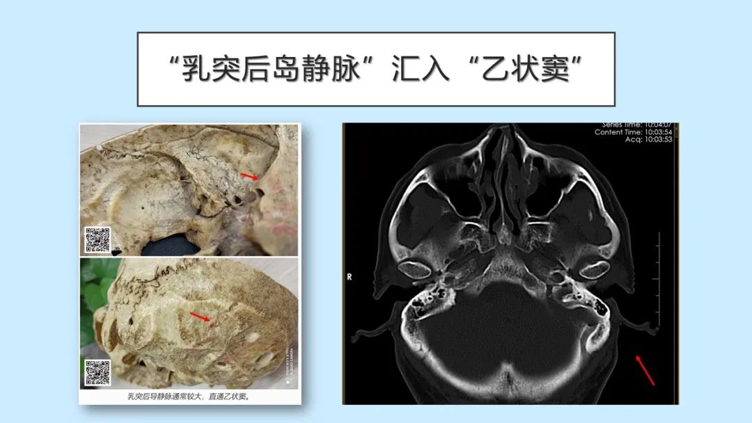 影像PPT - 【PPT】颅骨的孔裂、缝及骨折线CT读片-21