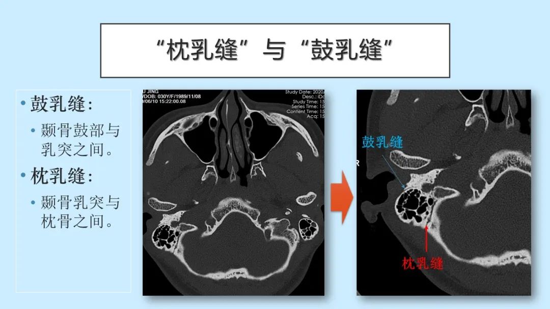 影像PPT - 【PPT】颅骨的孔裂、缝及骨折线CT读片-23