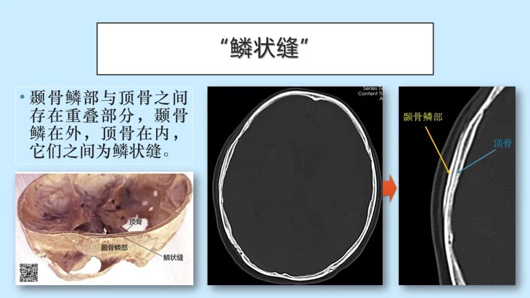 影像PPT - 【PPT】颅骨的孔裂、缝及骨折线CT读片-22
