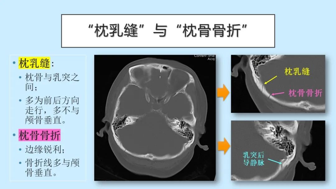 影像PPT - 【PPT】颅骨的孔裂、缝及骨折线CT读片-24
