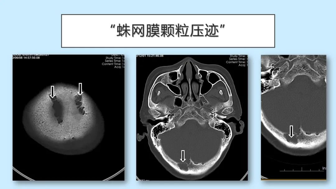 影像PPT - 【PPT】颅骨的孔裂、缝及骨折线CT读片-25