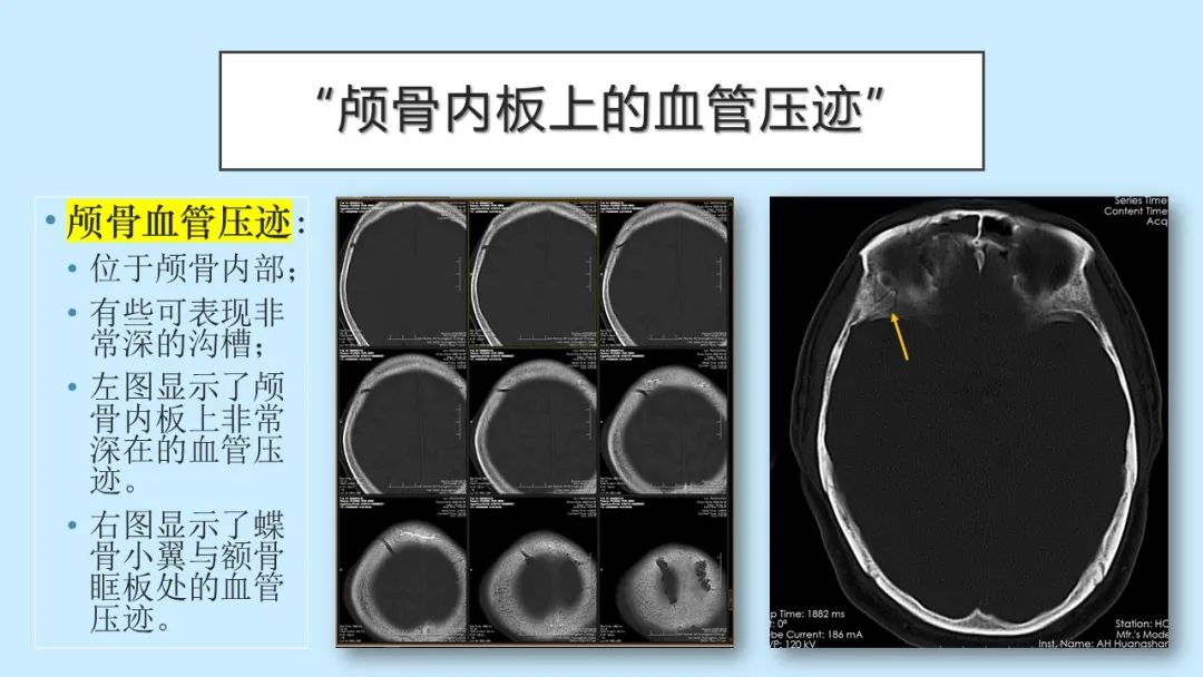影像PPT - 【PPT】颅骨的孔裂、缝及骨折线CT读片-26