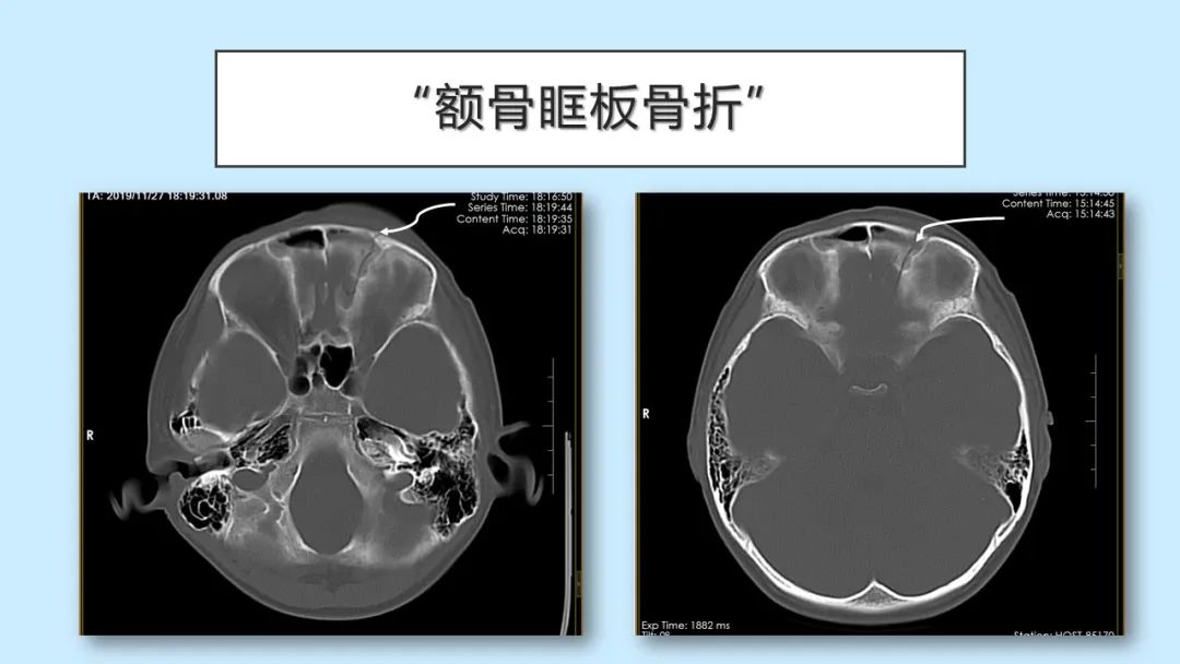 影像PPT - 【PPT】颅骨的孔裂、缝及骨折线CT读片-27