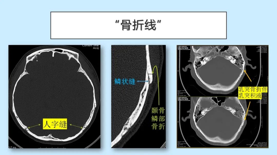 影像PPT - 【PPT】颅骨的孔裂、缝及骨折线CT读片-28
