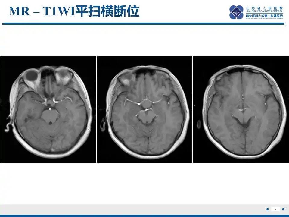 影像PPT - 【PPT】神经垂体颗粒细胞瘤-4
