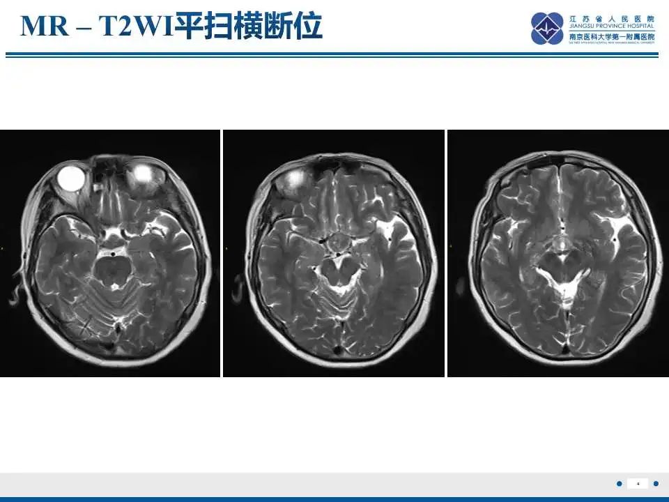 影像PPT - 【PPT】神经垂体颗粒细胞瘤-5