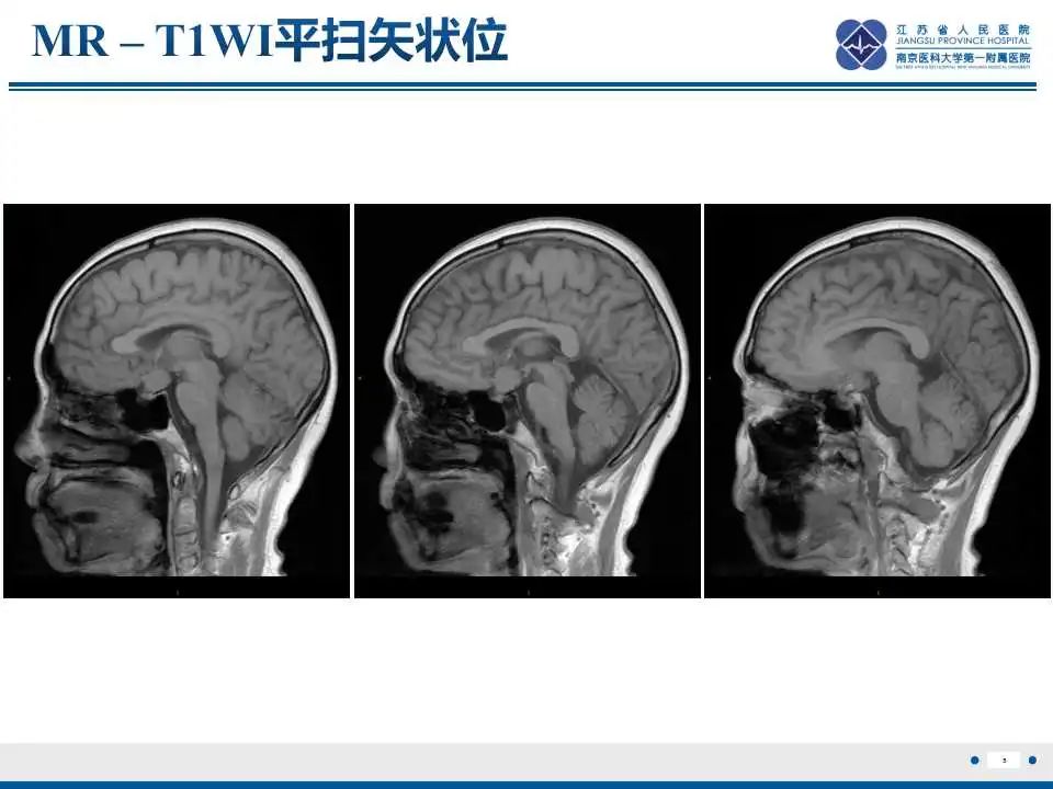 影像PPT - 【PPT】神经垂体颗粒细胞瘤-6