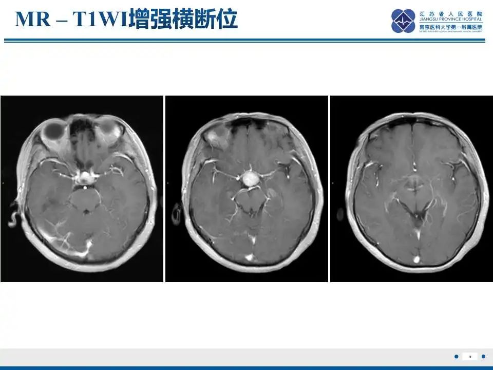 影像PPT - 【PPT】神经垂体颗粒细胞瘤-7