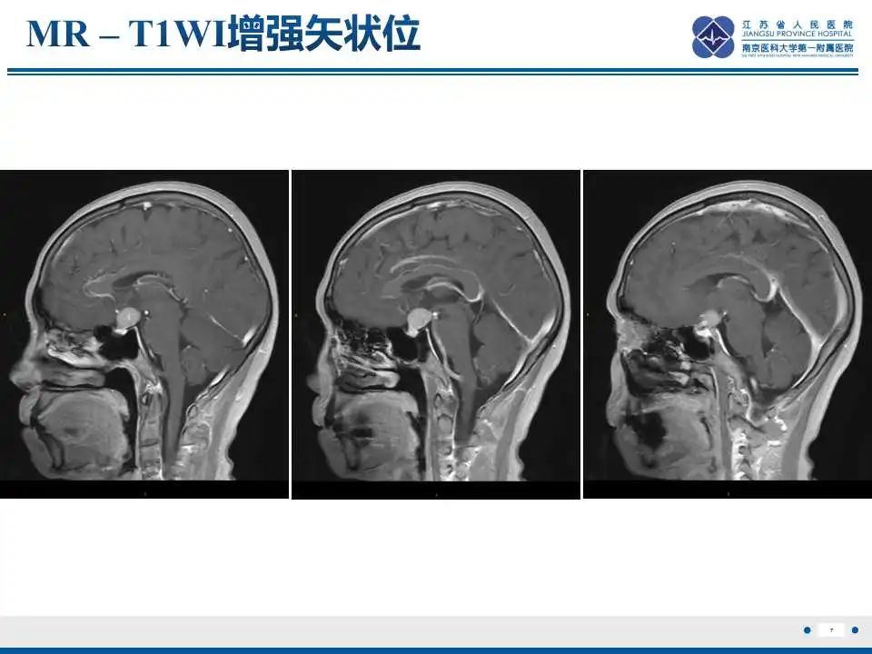 影像PPT - 【PPT】神经垂体颗粒细胞瘤-8