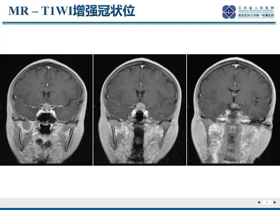 影像PPT - 【PPT】神经垂体颗粒细胞瘤-9