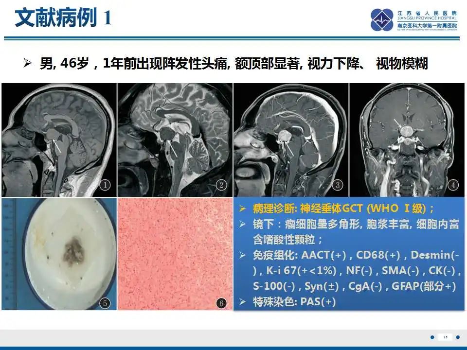 影像PPT - 【PPT】神经垂体颗粒细胞瘤-26