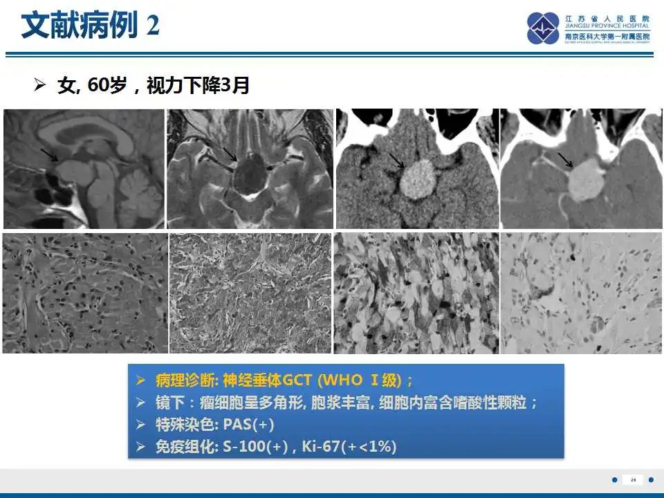 影像PPT - 【PPT】神经垂体颗粒细胞瘤-27