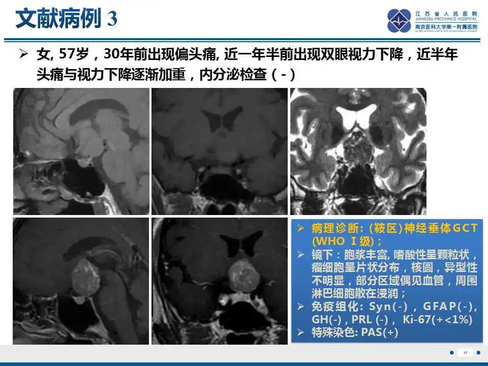 影像PPT - 【PPT】神经垂体颗粒细胞瘤-28