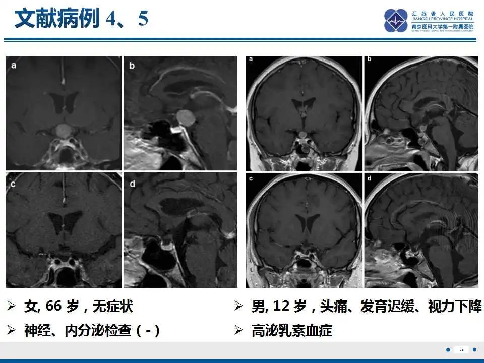 影像PPT - 【PPT】神经垂体颗粒细胞瘤-29