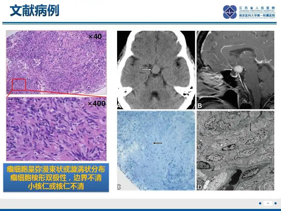 影像PPT - 【PPT】神经垂体颗粒细胞瘤-32