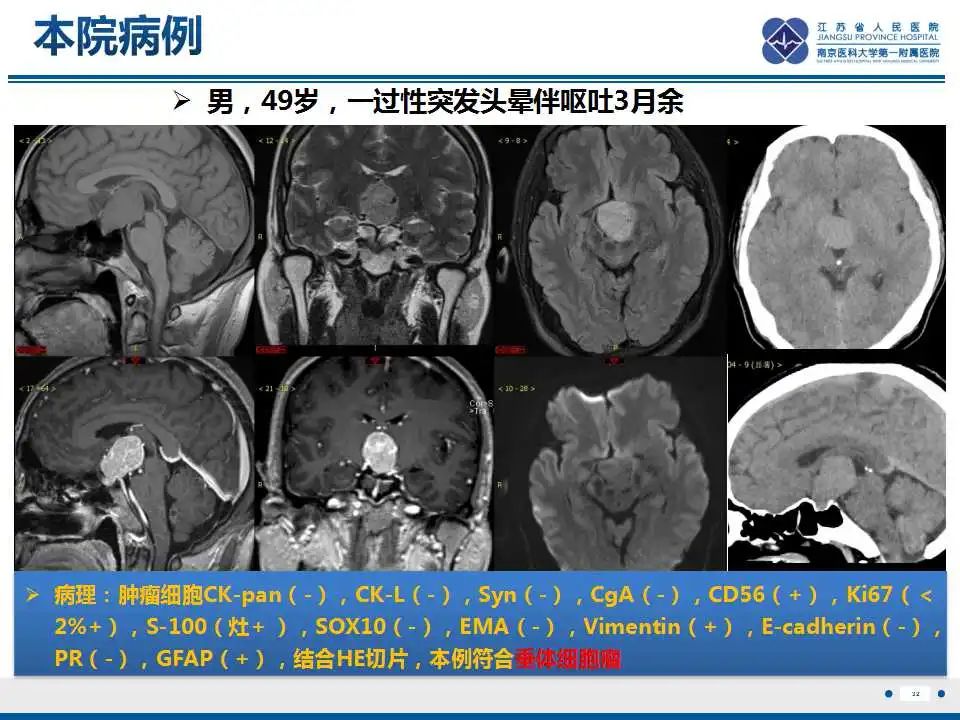 影像PPT - 【PPT】神经垂体颗粒细胞瘤-33