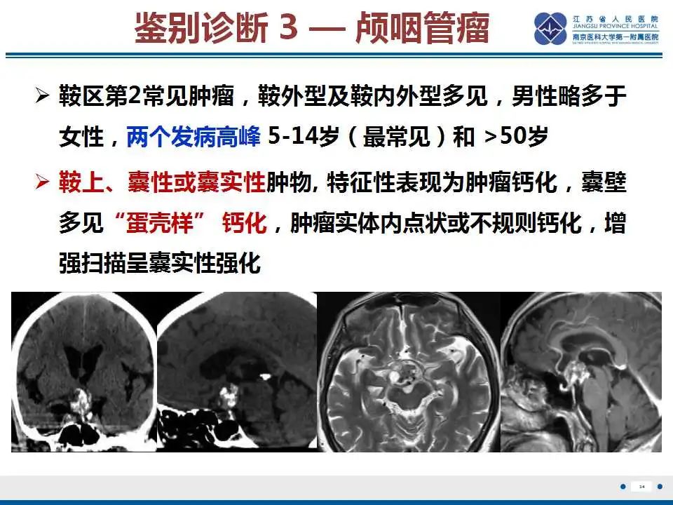 影像PPT - 【PPT】神经垂体颗粒细胞瘤-35