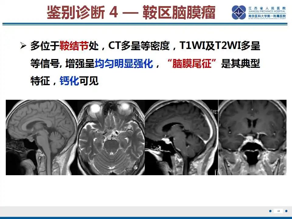 影像PPT - 【PPT】神经垂体颗粒细胞瘤-36