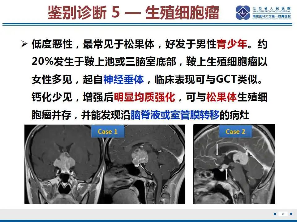 影像PPT - 【PPT】神经垂体颗粒细胞瘤-37