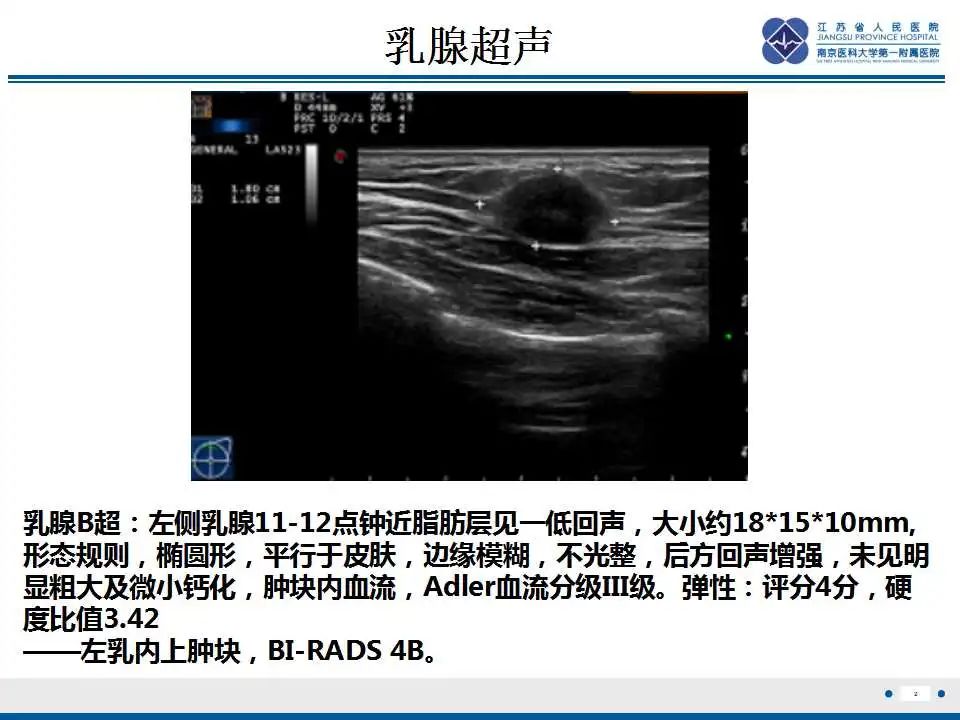 影像PPT - 【PPT】乳腺颗粒细胞瘤-3