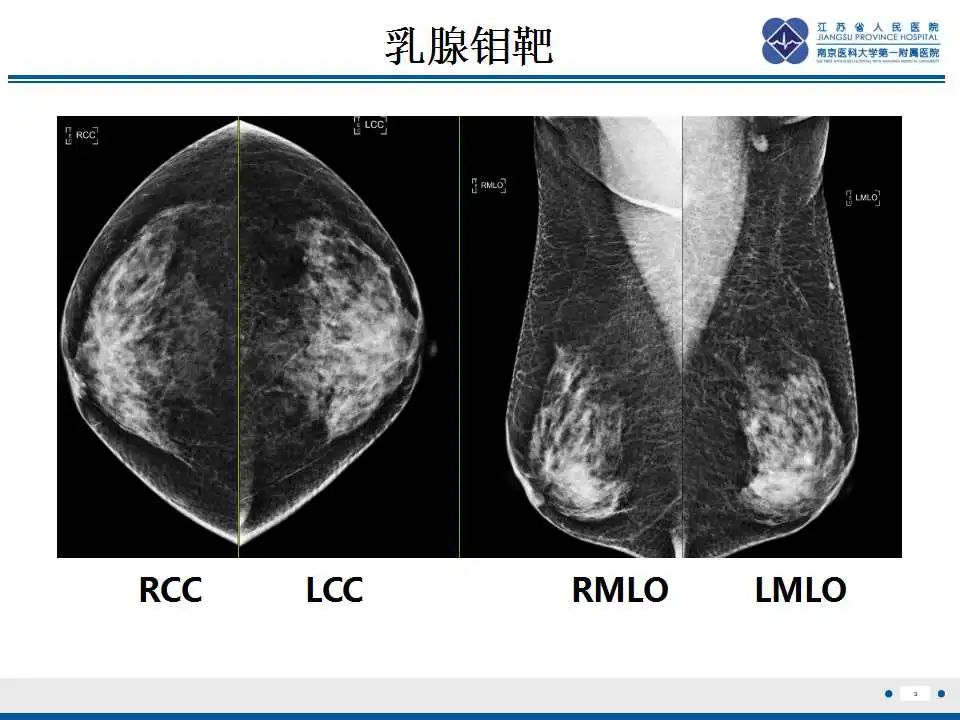 影像PPT - 【PPT】乳腺颗粒细胞瘤-4