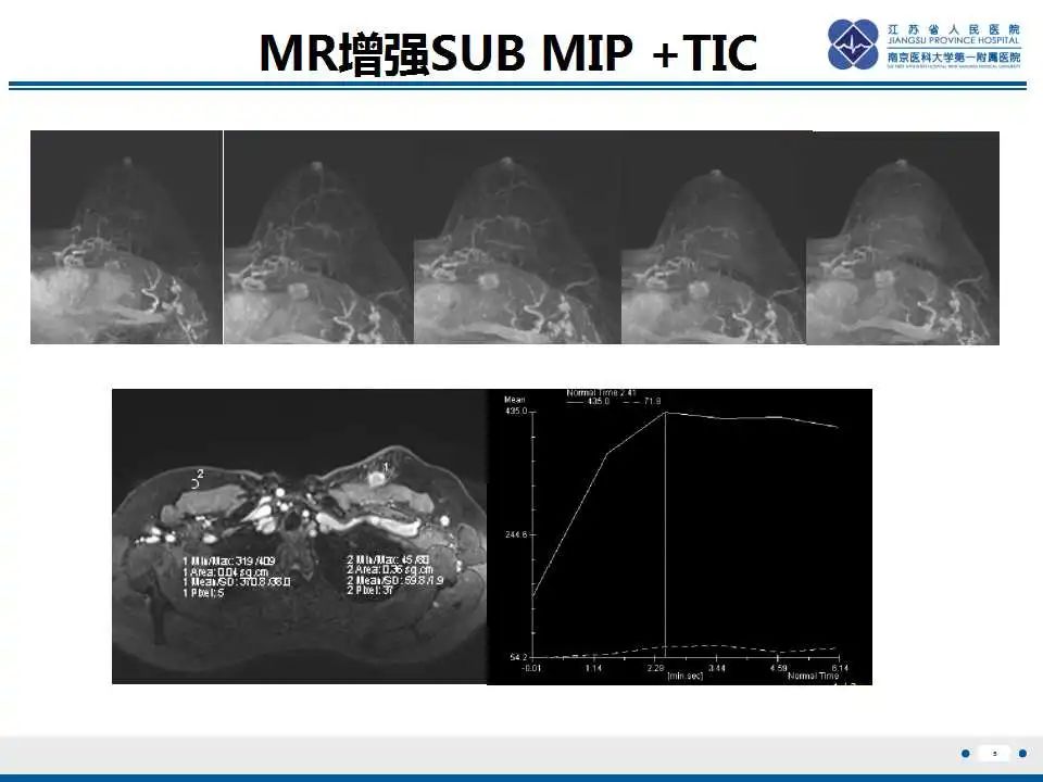 影像PPT - 【PPT】乳腺颗粒细胞瘤-6
