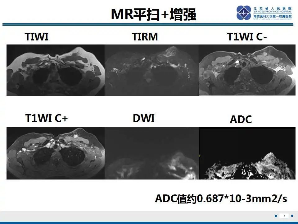 影像PPT - 【PPT】乳腺颗粒细胞瘤-5
