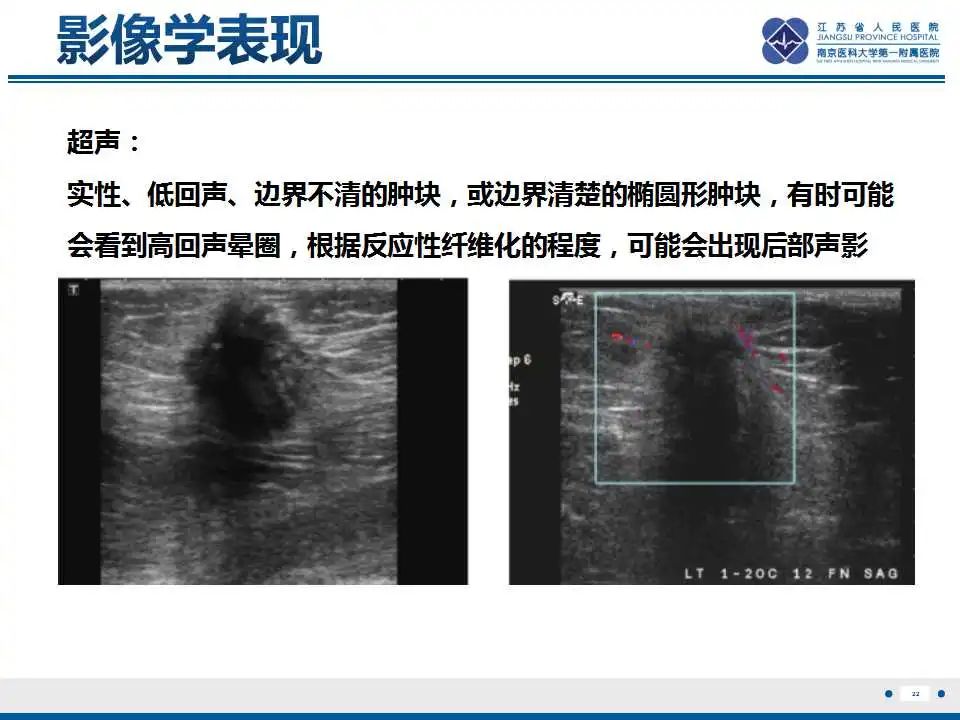 影像PPT - 【PPT】乳腺颗粒细胞瘤-23