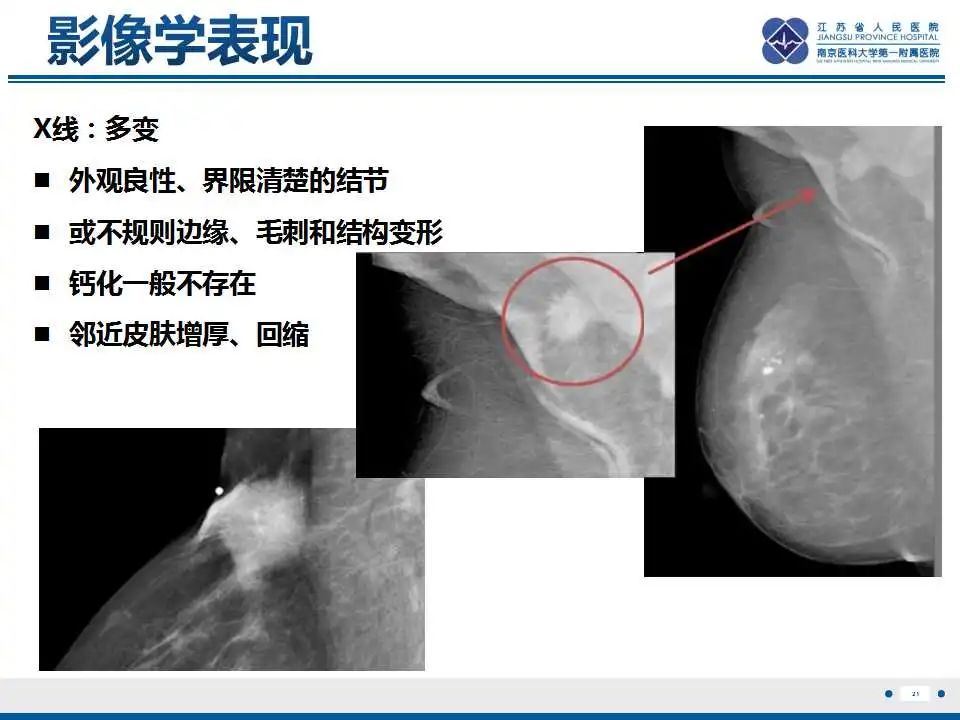 影像PPT - 【PPT】乳腺颗粒细胞瘤-22