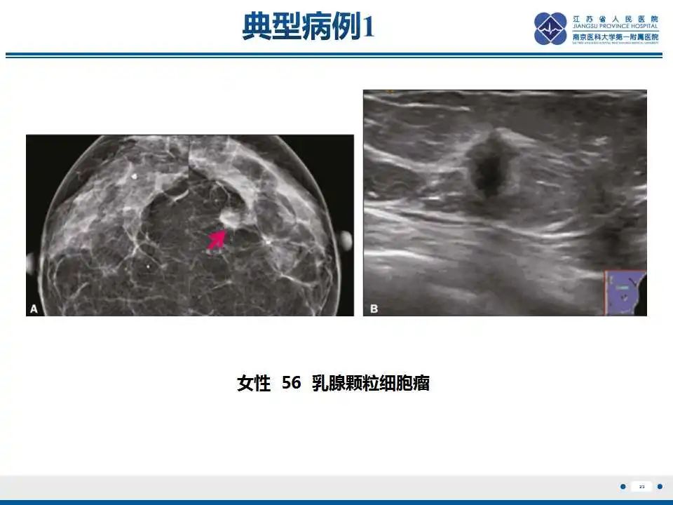 影像PPT - 【PPT】乳腺颗粒细胞瘤-24
