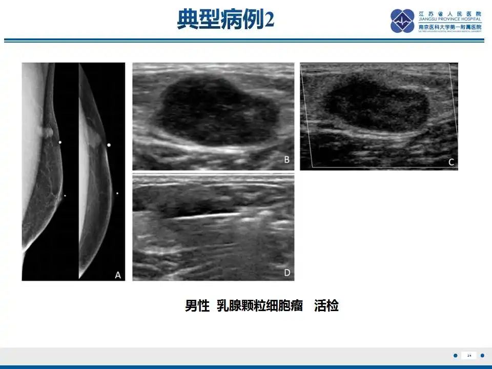 影像PPT - 【PPT】乳腺颗粒细胞瘤-25