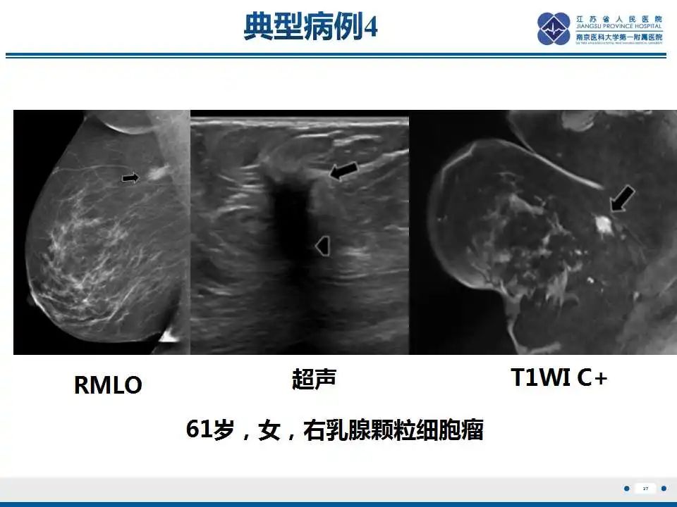 影像PPT - 【PPT】乳腺颗粒细胞瘤-28