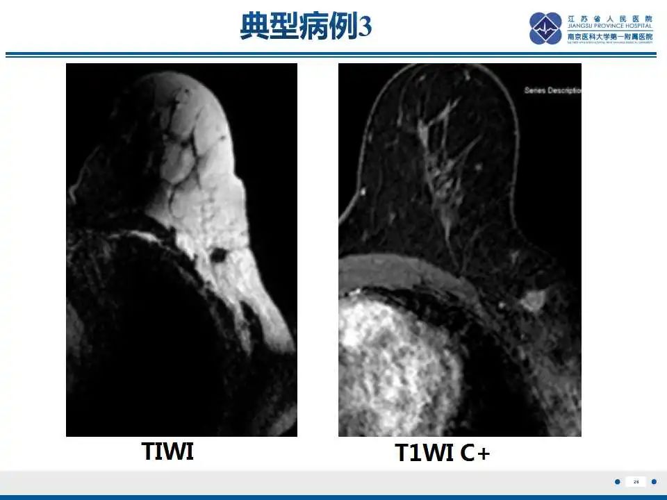 影像PPT - 【PPT】乳腺颗粒细胞瘤-27