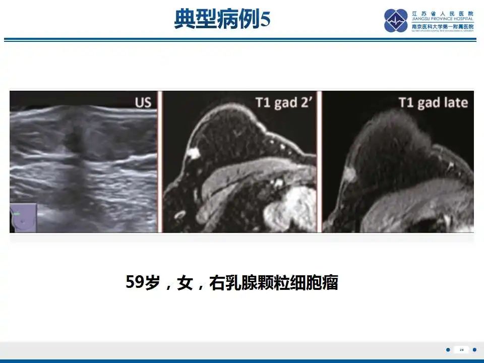 影像PPT - 【PPT】乳腺颗粒细胞瘤-29