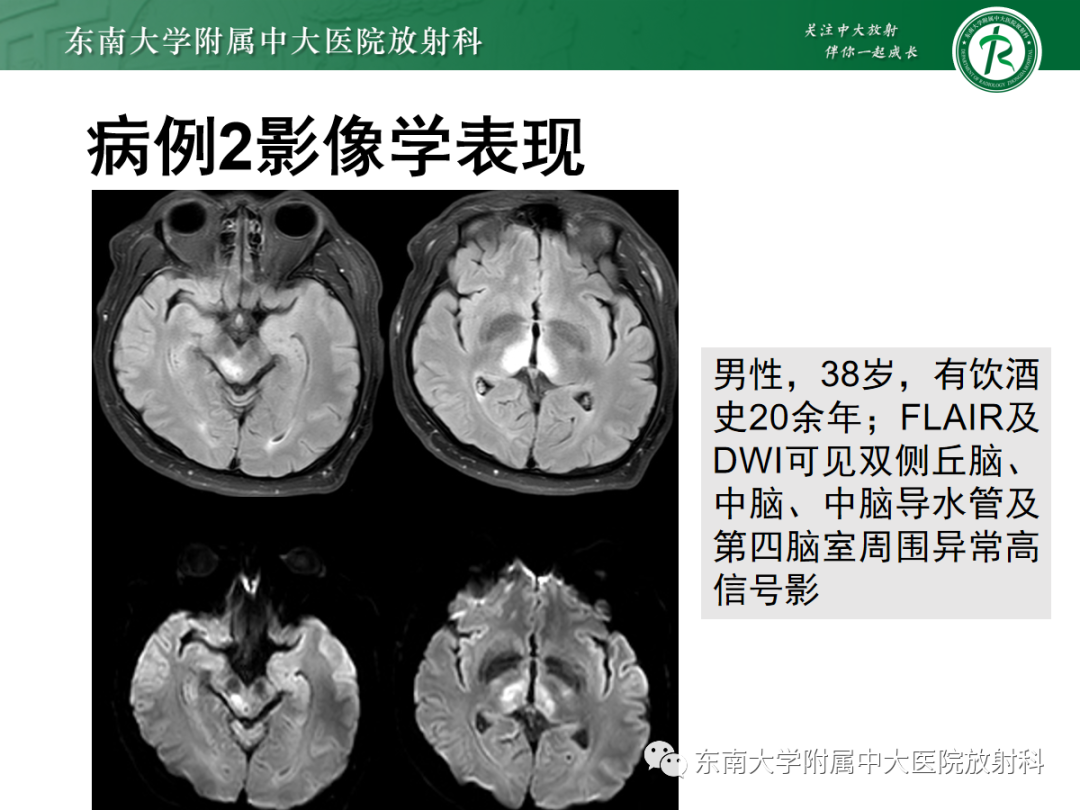 影像PPT - 【PPT】Wernicke脑病-12