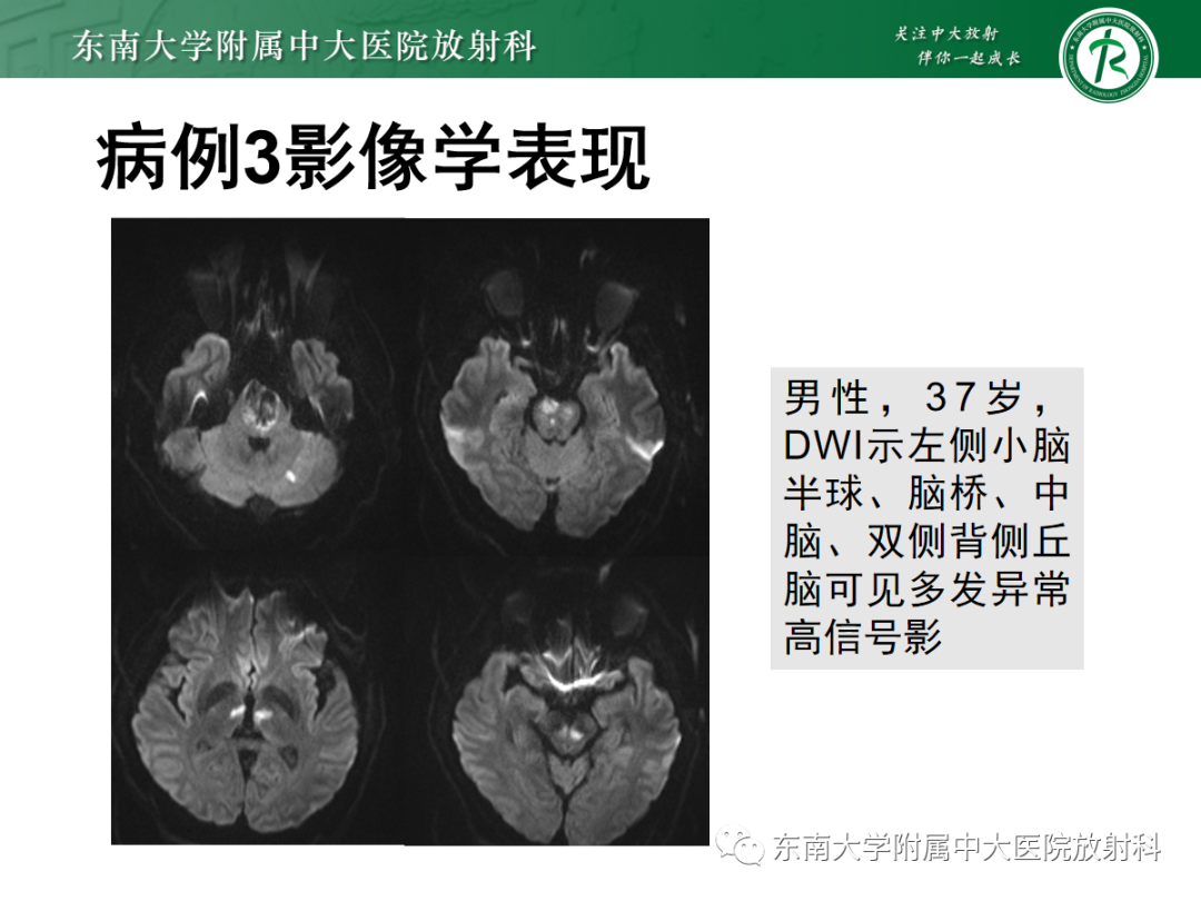 影像PPT - 【PPT】Wernicke脑病-19