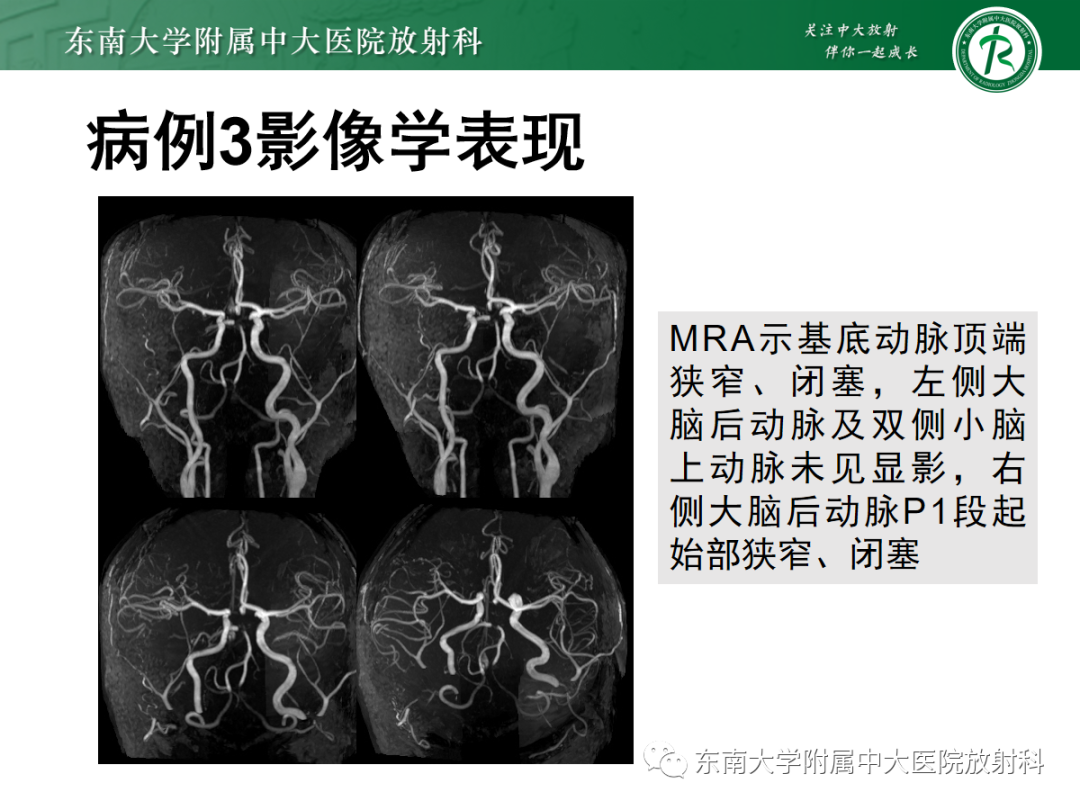 影像PPT - 【PPT】Wernicke脑病-20