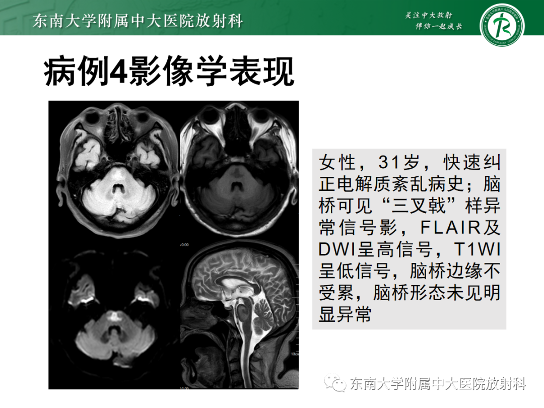 影像PPT - 【PPT】Wernicke脑病-27