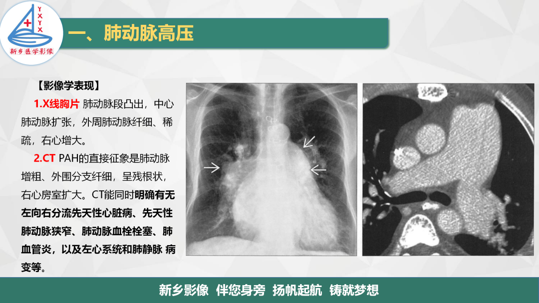 影像PPT - 【PPT】医学影像诊断学教材解读—肺循环病变的影像表现-4