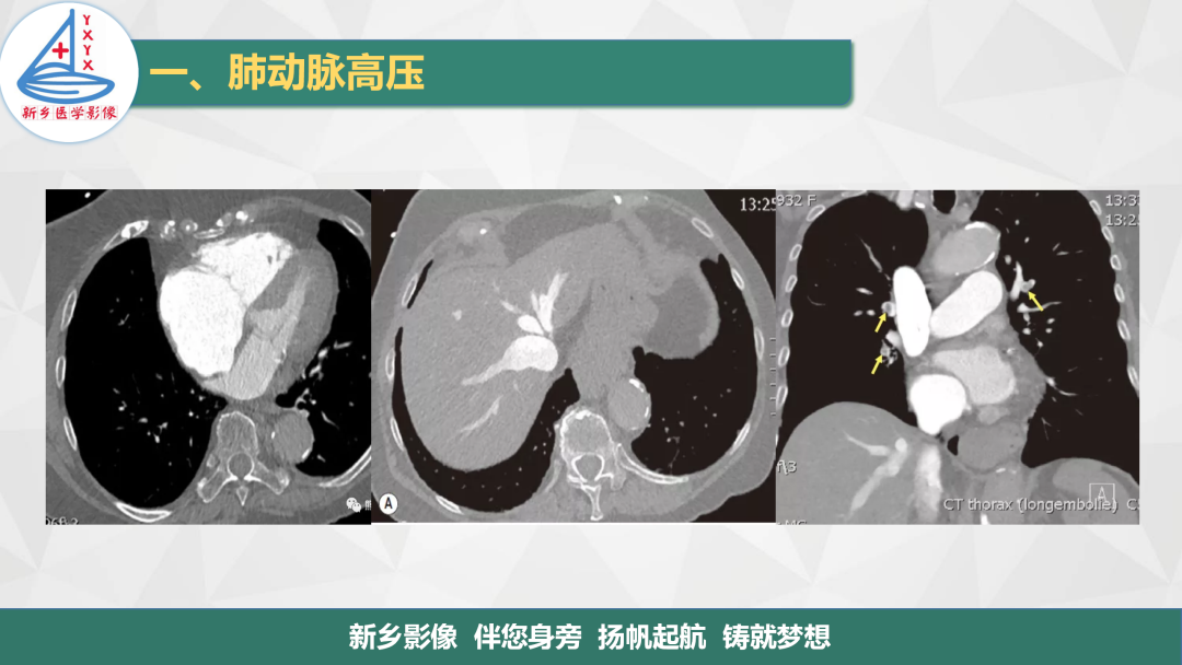 影像PPT - 【PPT】医学影像诊断学教材解读—肺循环病变的影像表现-5