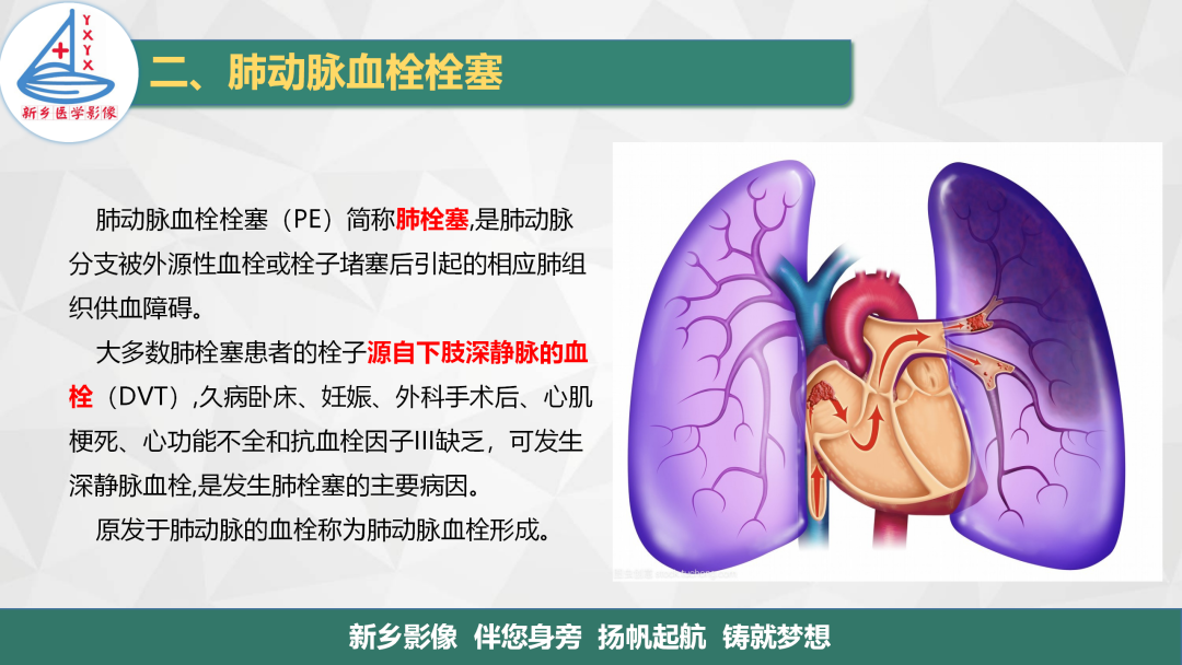影像PPT - 【PPT】医学影像诊断学教材解读—肺循环病变的影像表现-7