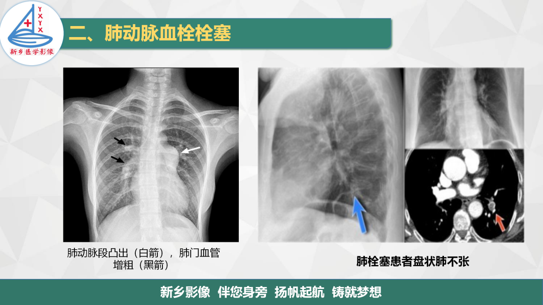 影像PPT - 【PPT】医学影像诊断学教材解读—肺循环病变的影像表现-10
