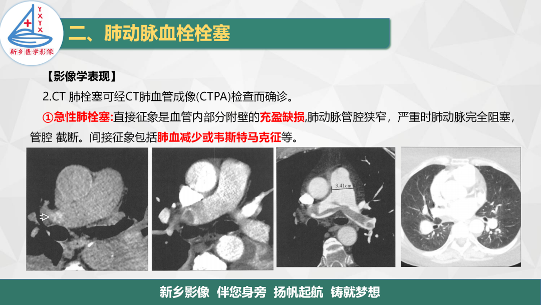 影像PPT - 【PPT】医学影像诊断学教材解读—肺循环病变的影像表现-12