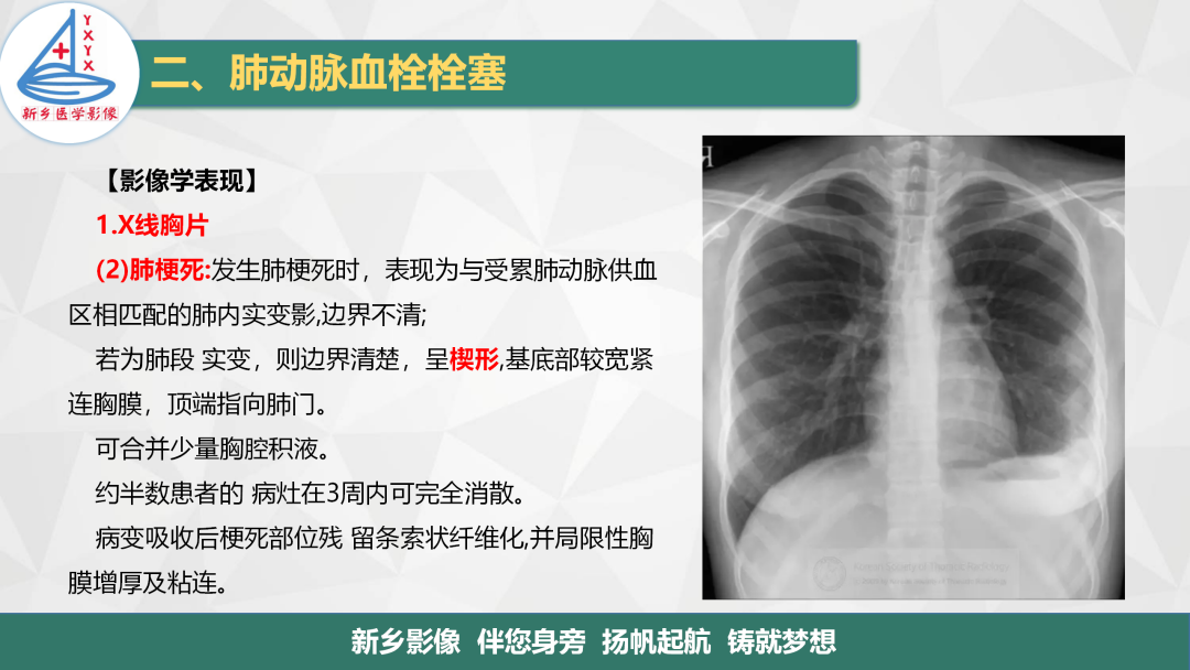 影像PPT - 【PPT】医学影像诊断学教材解读—肺循环病变的影像表现-11