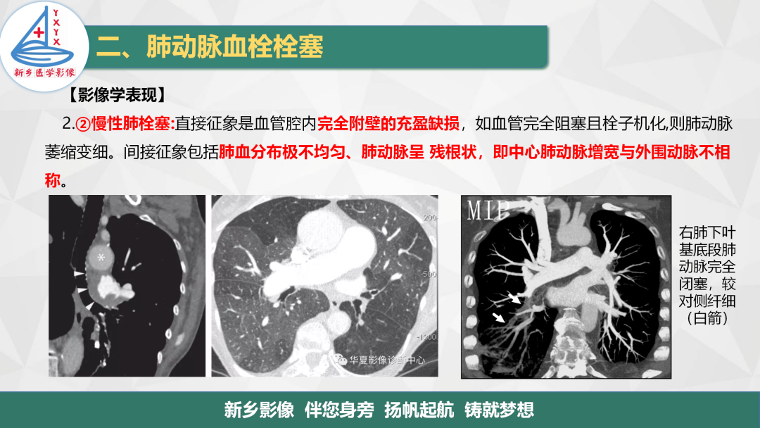 影像PPT - 【PPT】医学影像诊断学教材解读—肺循环病变的影像表现-13