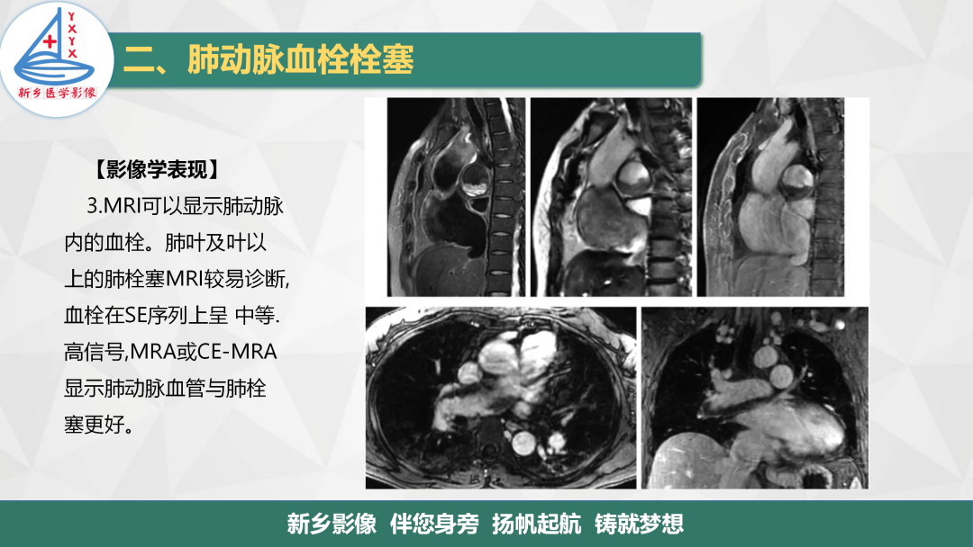 影像PPT - 【PPT】医学影像诊断学教材解读—肺循环病变的影像表现-15