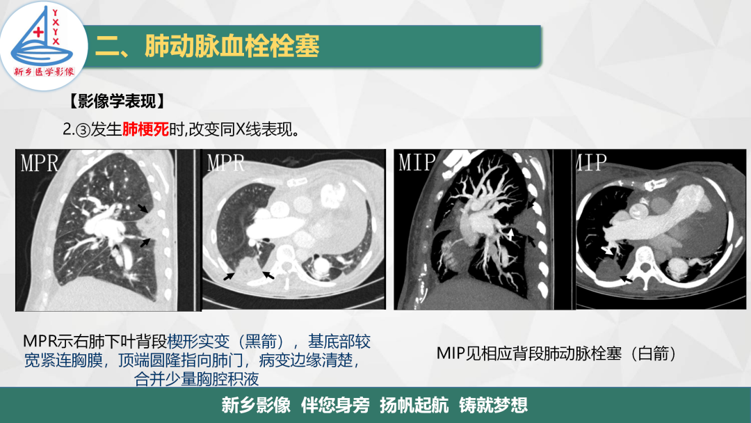 影像PPT - 【PPT】医学影像诊断学教材解读—肺循环病变的影像表现-14